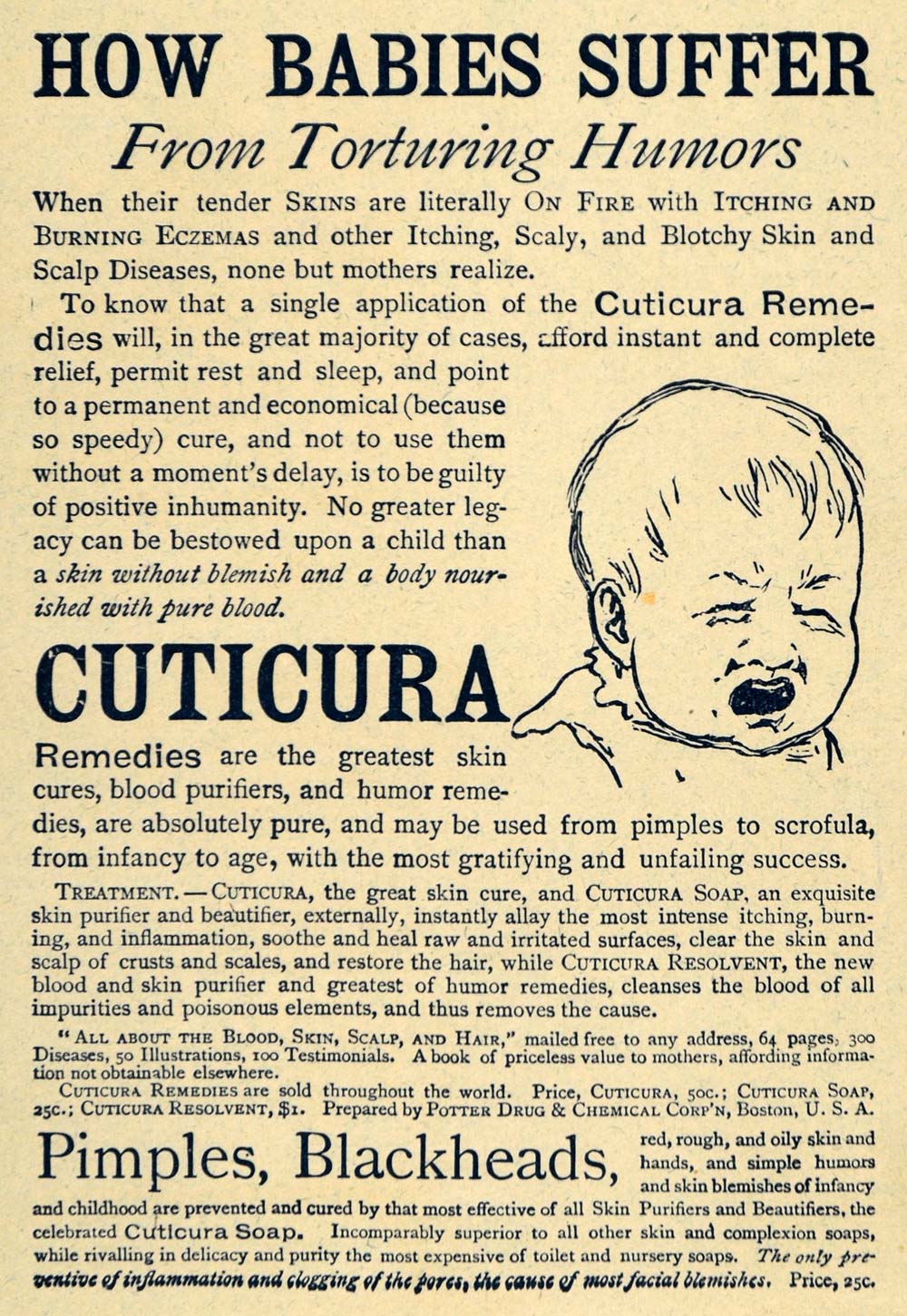 1892 Ad Potter Drug Chemical Cuticura Baby Remedies Skin Care Pimples LHJ4