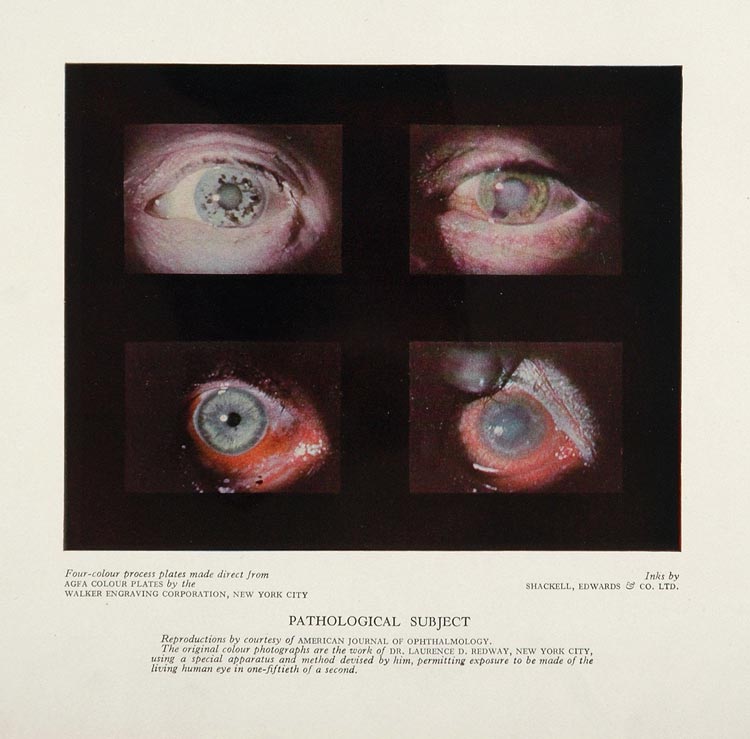 1930 Human Eye Pathology Laurence D. Redway Color Print - ORIGINAL