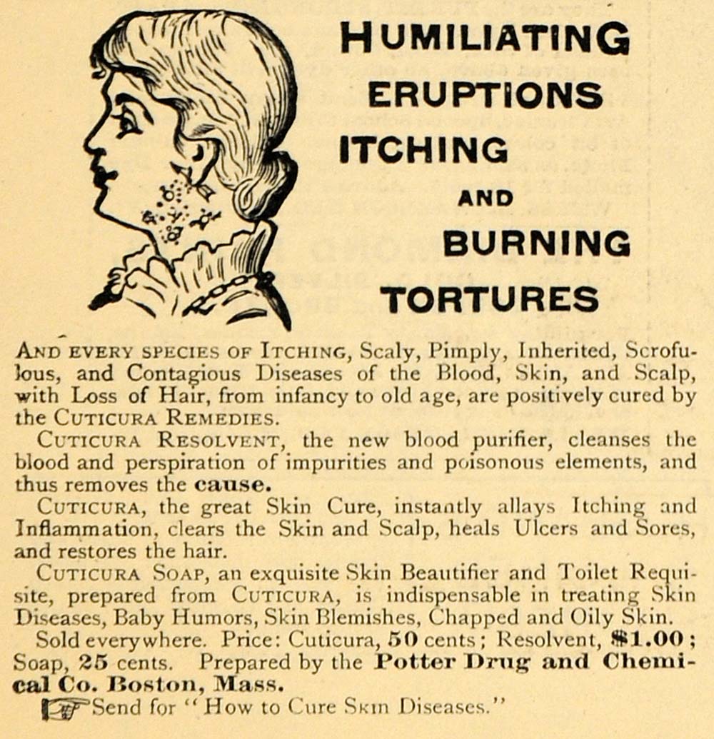 1885 Ad Potter Drug Chemical Cuticura Cures Itch Burn - ORIGINAL TCM1